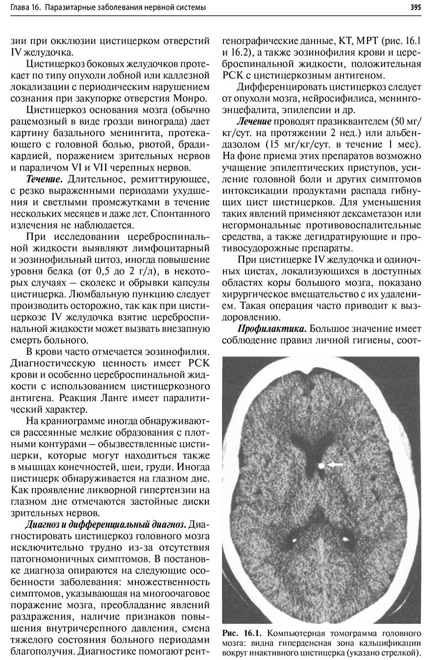 Рис. 16.1. Компьютерная томограмма головного мозга: видна гипсрдснсная зона кальцификации