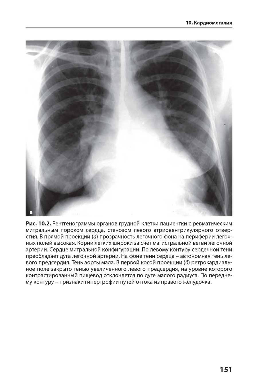 Рис. 10.2. Рентгенограммы органов грудной клетки пациентки с ревматическим митральным пороком сердца, стенозом левого атриовентрикулярного отверстия