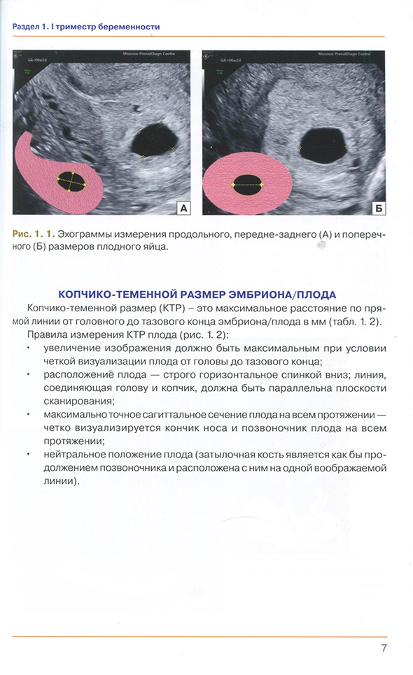 Рис. 1.1. Эхограммы измерения продольного, передне-заднего (А) и поперечного (Б) размеров плодного яйца.