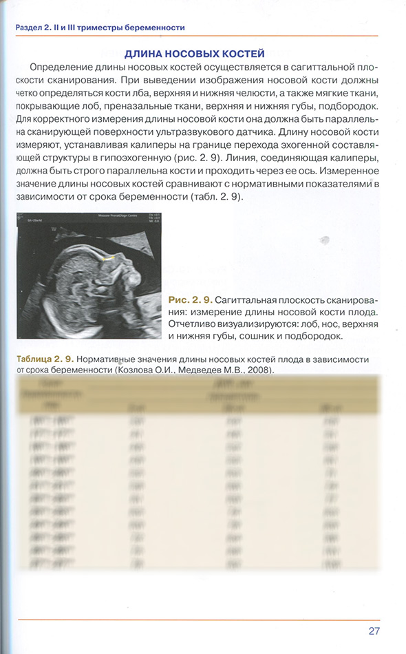 Рис. 2.9. Сагиттальная плоскость сканирования: измерение длины носовой кости плода.