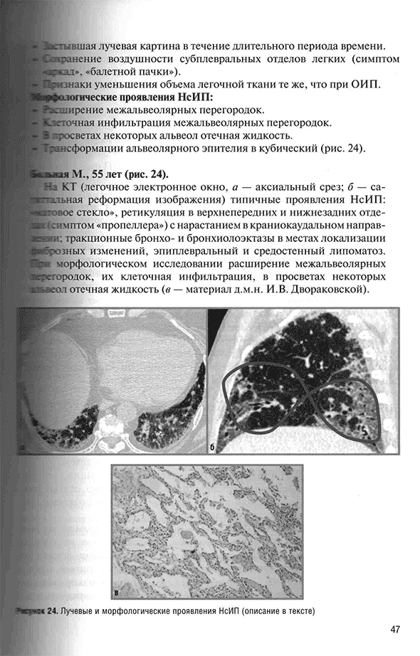 Лучевые и морфологические проявления НсИП (описание в тексте)