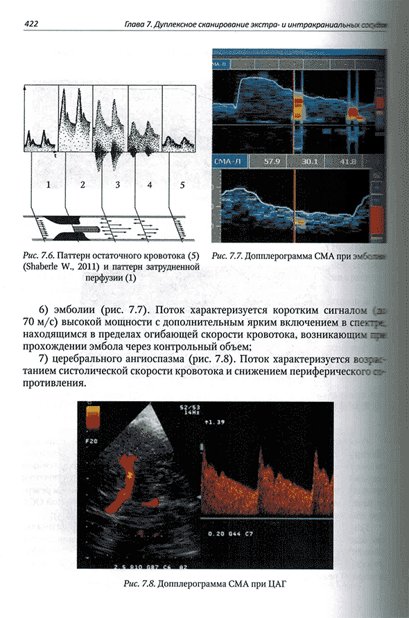 Допплерограмма СМА при ЦАГ