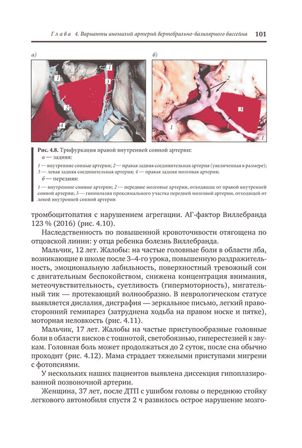 Трифуркация правой внутренней сонной артерии