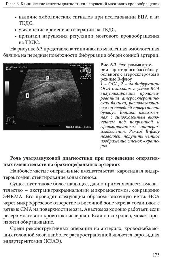 Рис. 6.3. Эхограмма артерии каротидного бассейна у больного с атеросклерозом в режиме В-флоу