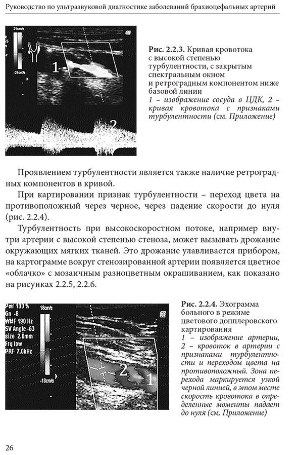 Рис. 2.2.4. Эхограмма больного в режиме цветового допплеровского картирования