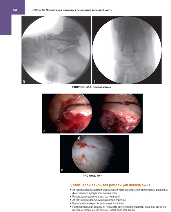 Чрескожная фиксация переломов таранной кости