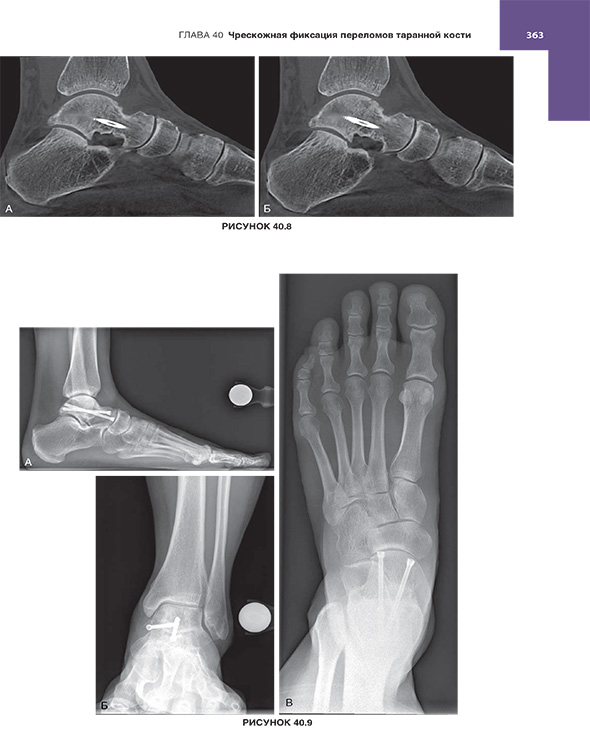 Чрескожная фиксация переломов таранной кости