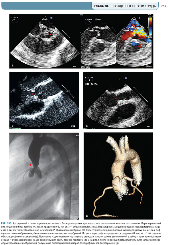 Врожденный стеноз аортального клапана. Эхокардиограмма двустворчатого аортального клапана со стенозом Врожденный стеноз аортального клапана. Эхокардиограмма двустворчатого аортального клапана со стенозом