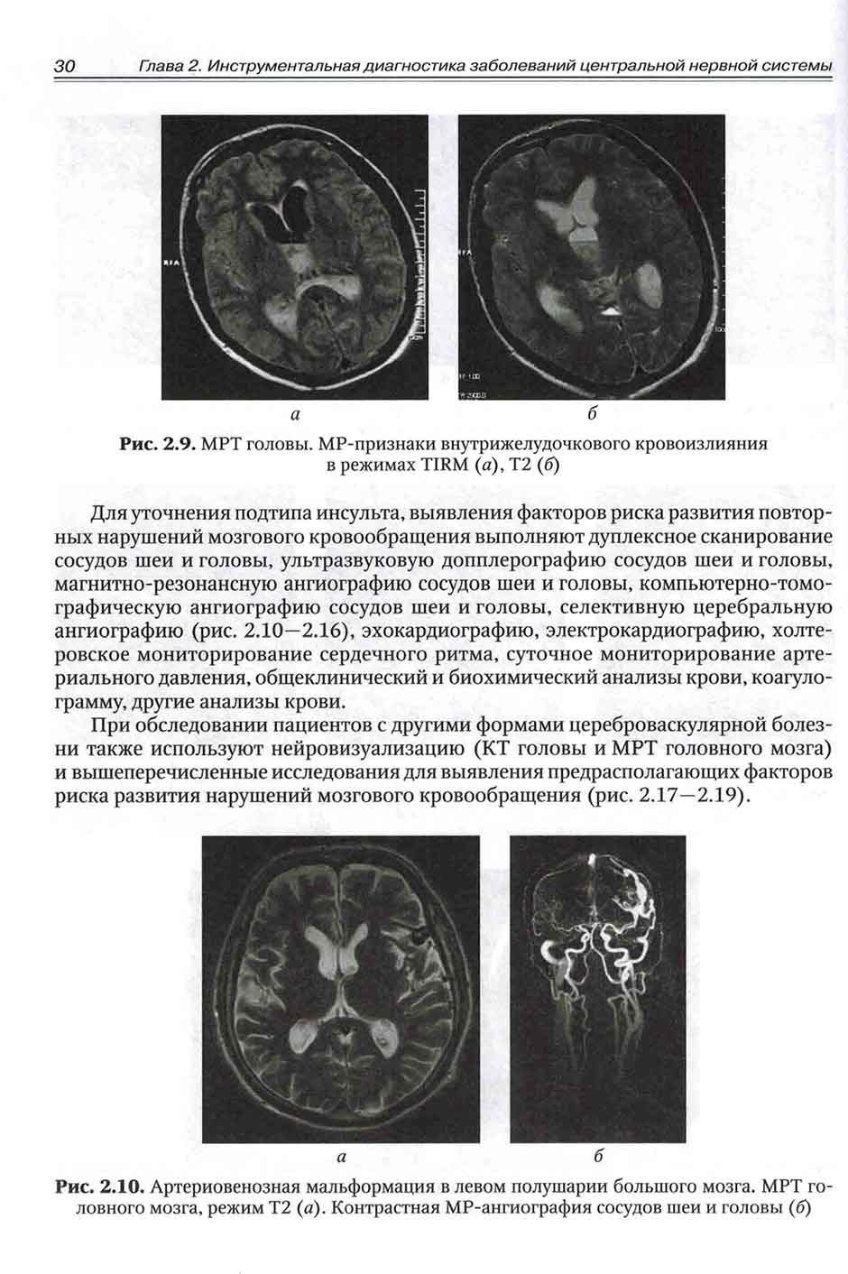 Рис. 2.10. Артериовенозная мальформация в левом полушарии большого мозга.