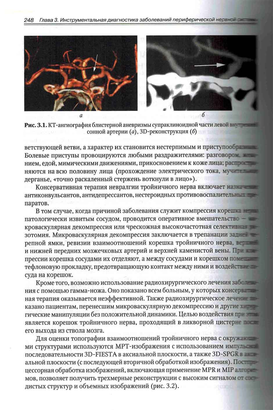 Рис. 3.1. КТ-ангиография блистерной аневризмы супраклиноидной части