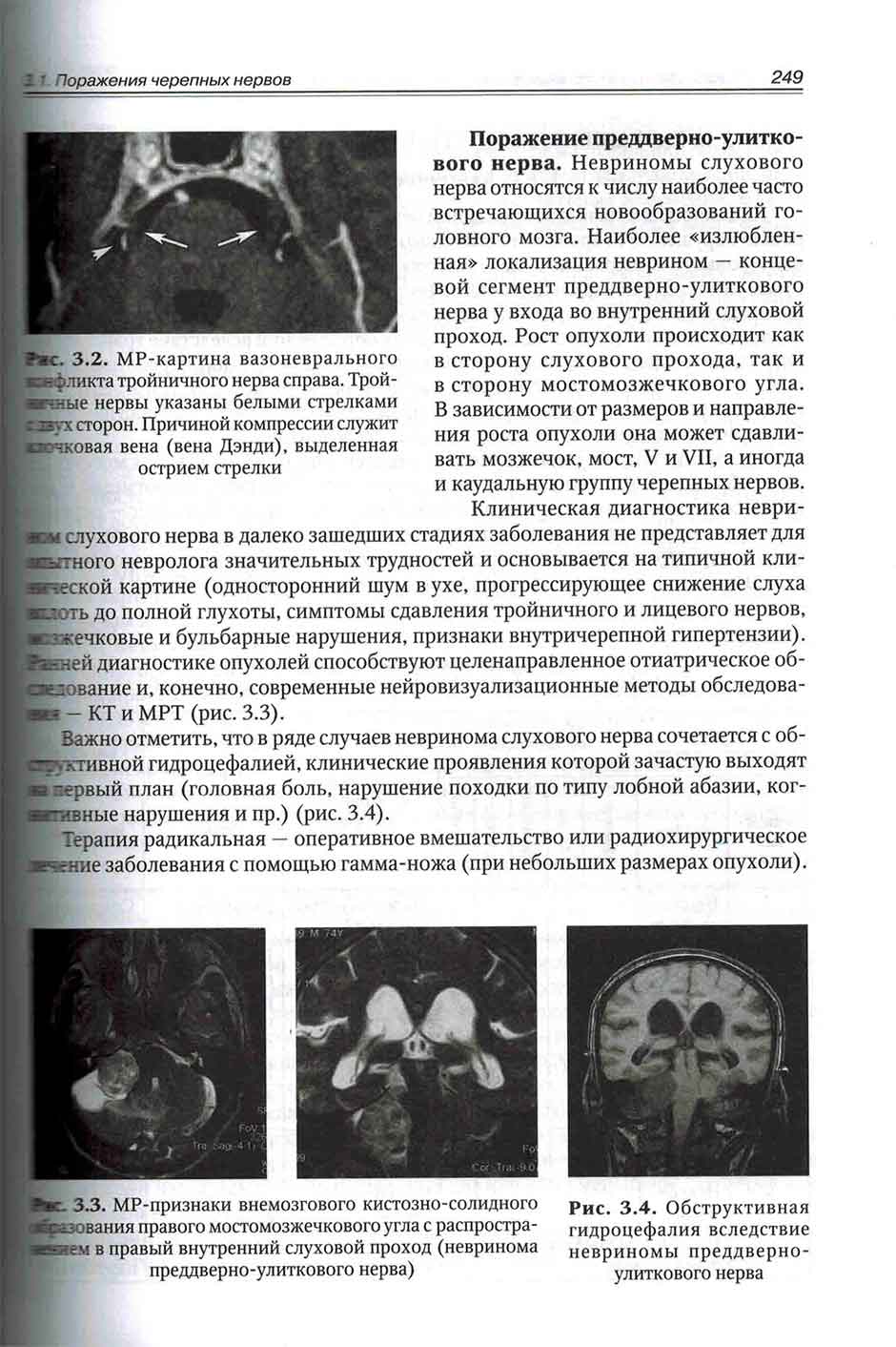 Рис. 3.4. Обструктивная гидроцефалия вследствие невриномы преддверно-улиткового нерва