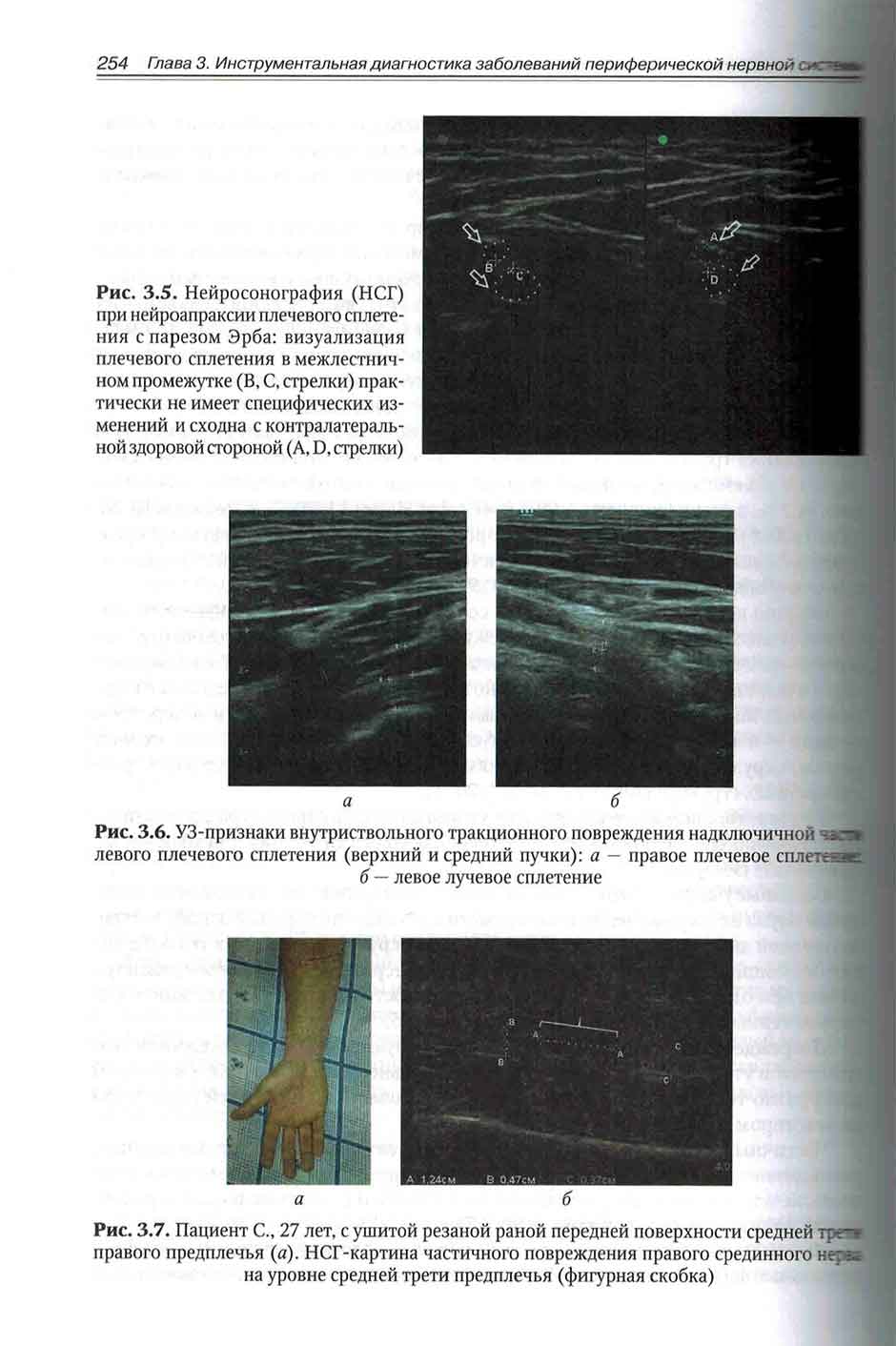 Рис. 3.6. УЗ-признаки внутриствольного тракционного повреждения надключичной левого плечевого сплетения 