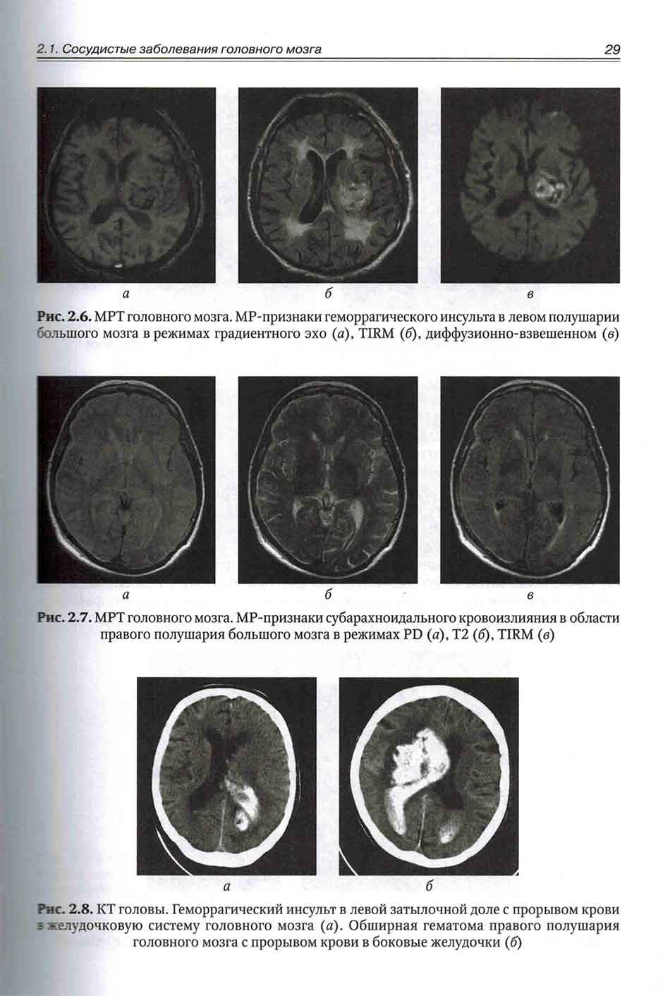 Рис. 2.7. МРТ головного мозга.