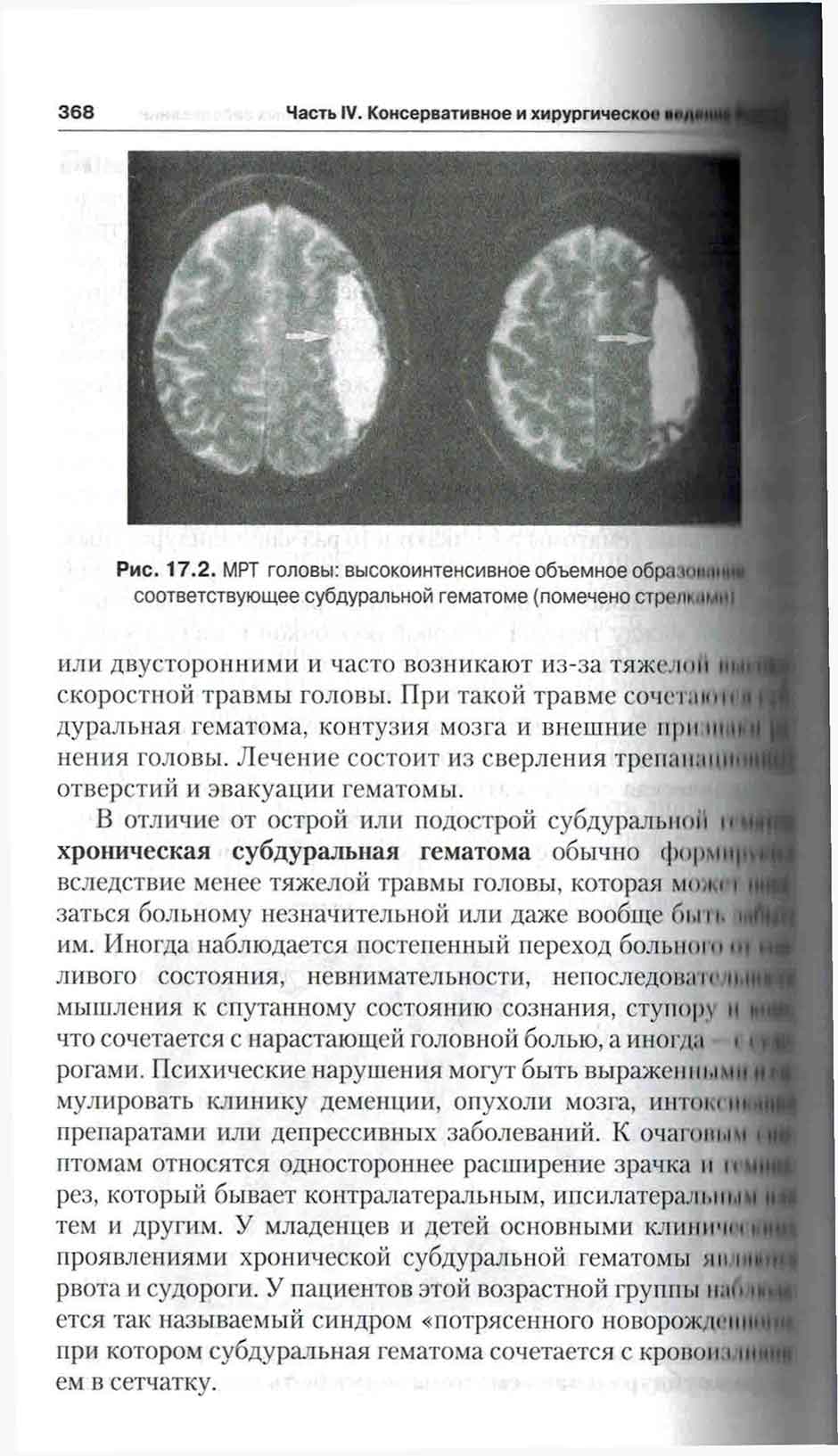 Рис. 17.2. MPT головы: высокоинтенсивное объемное образование соответствующее субдуральной гематоме 