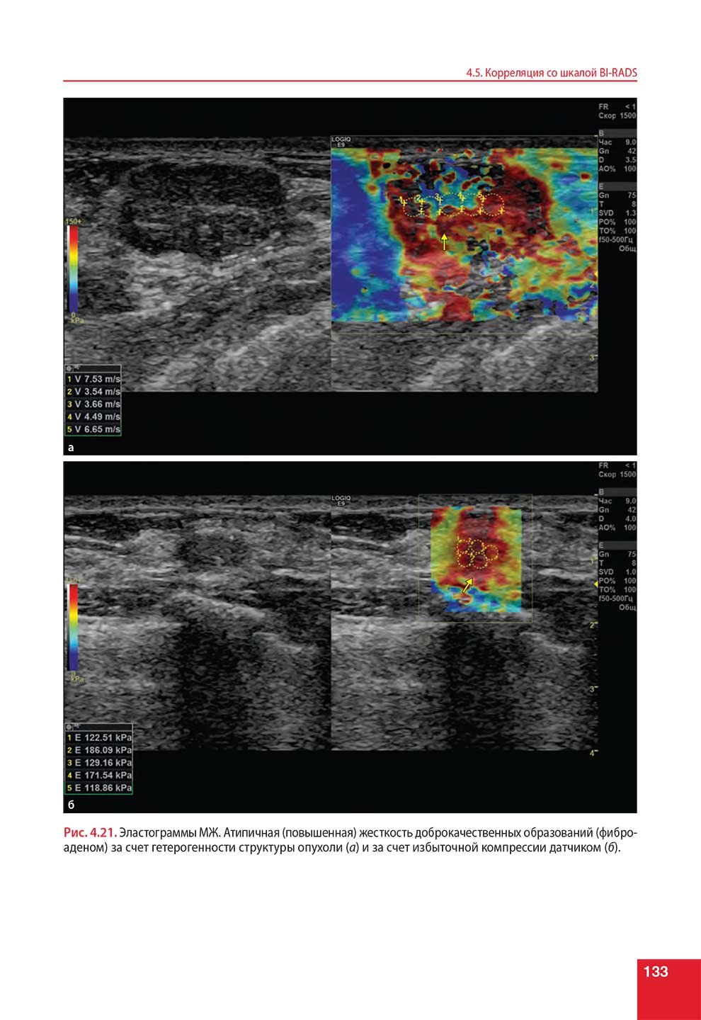 Эластограммы МЖ. Атипичная (повышенная) жесткость доброкачественных образований