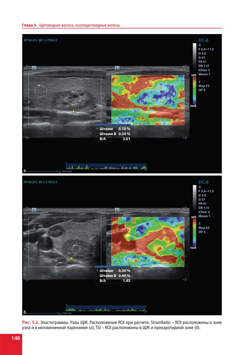 Эластограммы. Узлы ЩЖ. Расположение ROI при расчете: StrainRatio