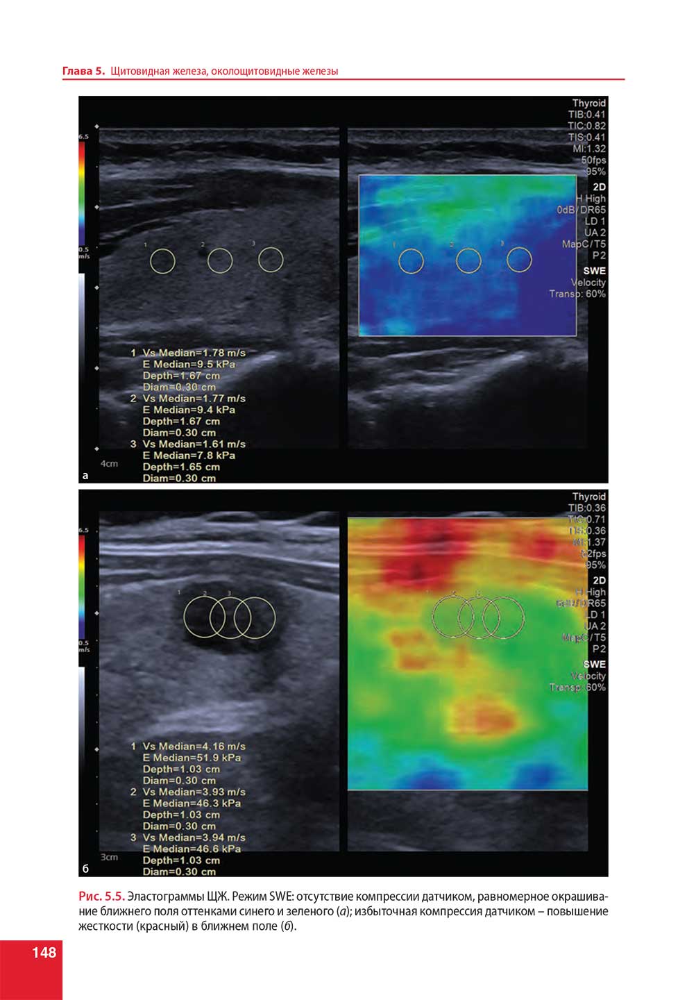 Эластограммы ЩЖ. Режим SWE: отсутствие компрессии датчиком.