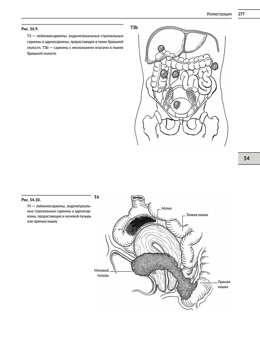 Т4 — лейомиосаркомыдо, энметриальные стромальные саркомы и аденосаркомы прорастающие в мочевой пузырь или прямую кишку