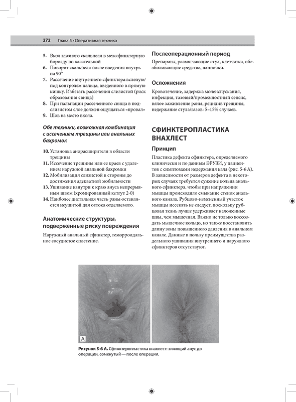 А. Сфинктеропластика внахлест: зияющий анус до операции, сомкнутый—после операции.