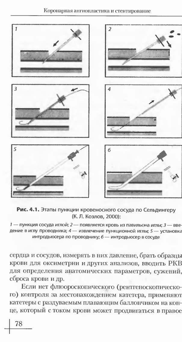 Этапы пункции кровеносного сосуда по Сельдингеру Этапы пункции кровеносного сосуда по Сельдингеру