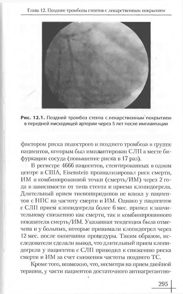 Поздний тромбоз стента с лекарственным покрытием в передней нисходящей артерии через 5 лет после имплантации Поздний тромбоз стента с лекарственным покрытием в передней нисходящей артерии через 5 лет после имплантации