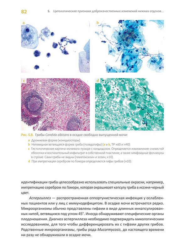 Грибы Candida albicans в осадке мочи