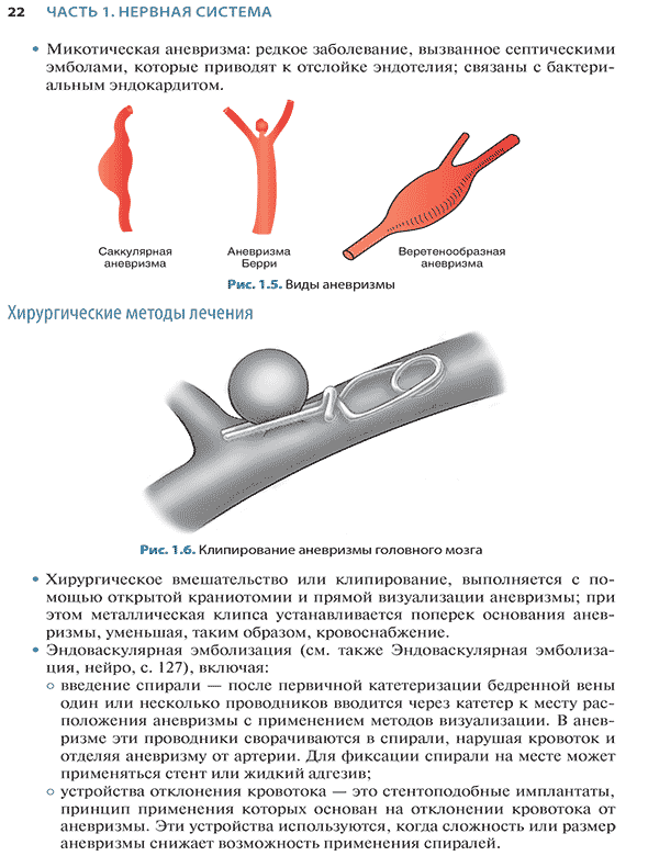 Рис. 1.6. Клипирование аневризмы головного мозга