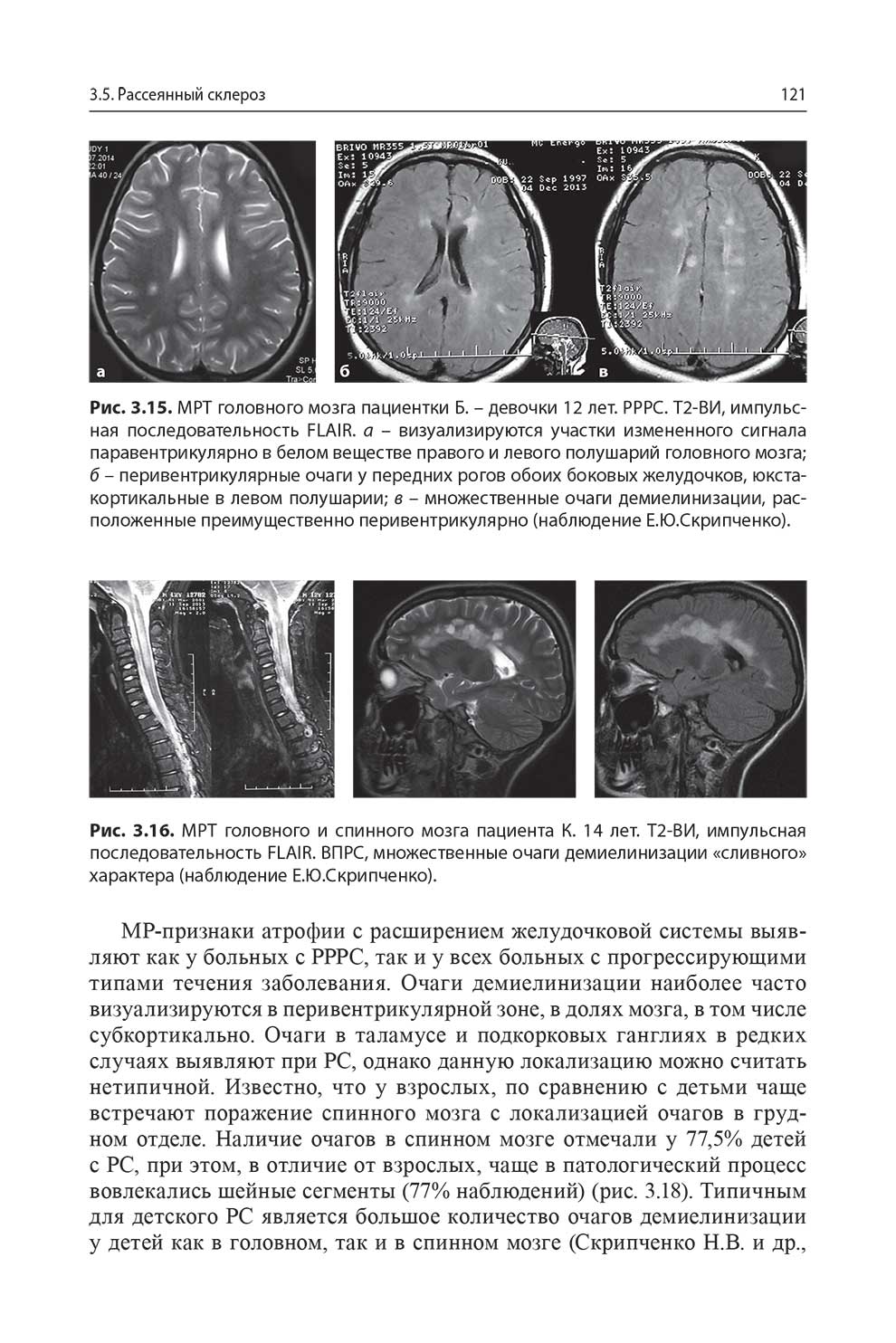 MPT головного и спинного мозга пациента К. 14 лет. Т2-ВИ,