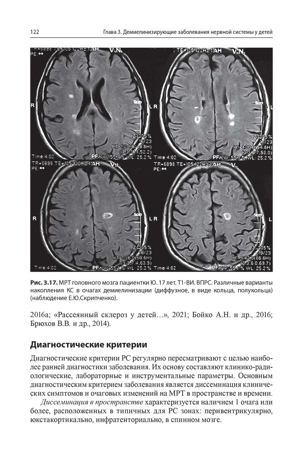 MPT головного мозга пациентки Ю. 17 лет.