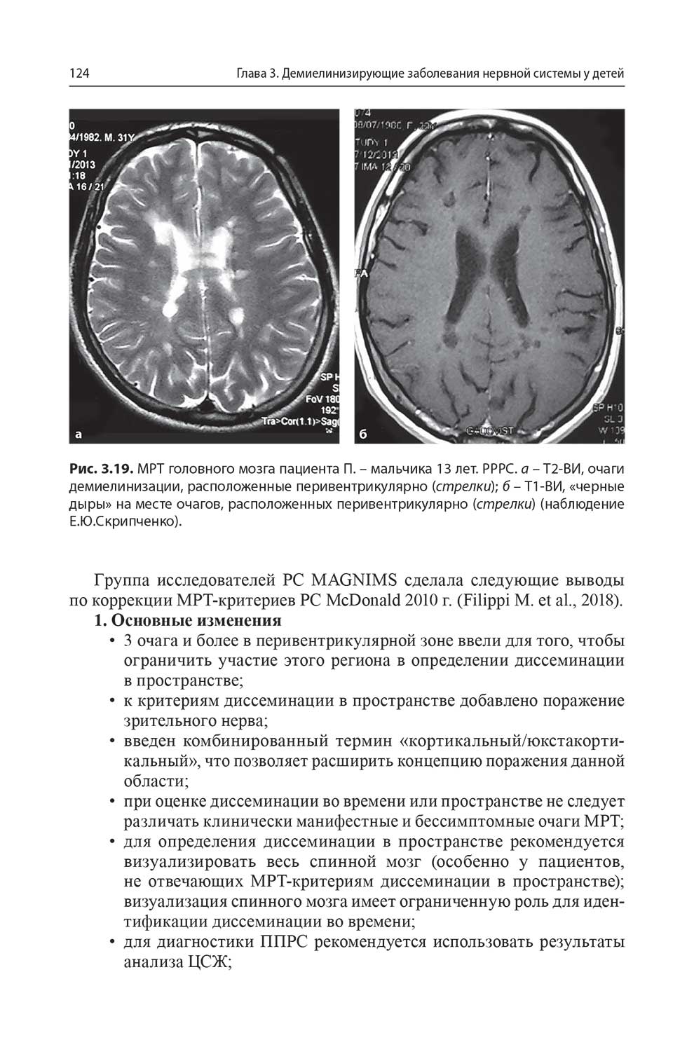 MPT головного мозга пациента П. - мальчика 13 лет. РРРС.