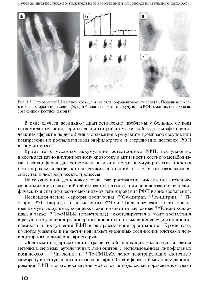 Рис. 1.2. Остеомиелит III пястной кости