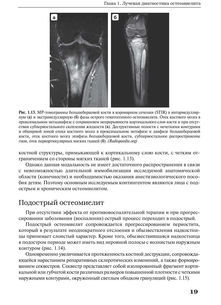Рис. 1.13. MP-томограммы большеберцовой кости в коронарном сечении (STIR)
