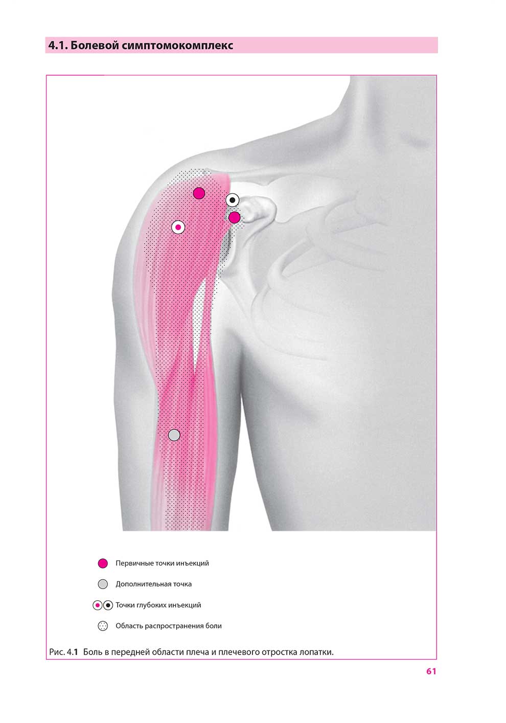 Боль в передней области плеча и плечевого отростка лопатки
