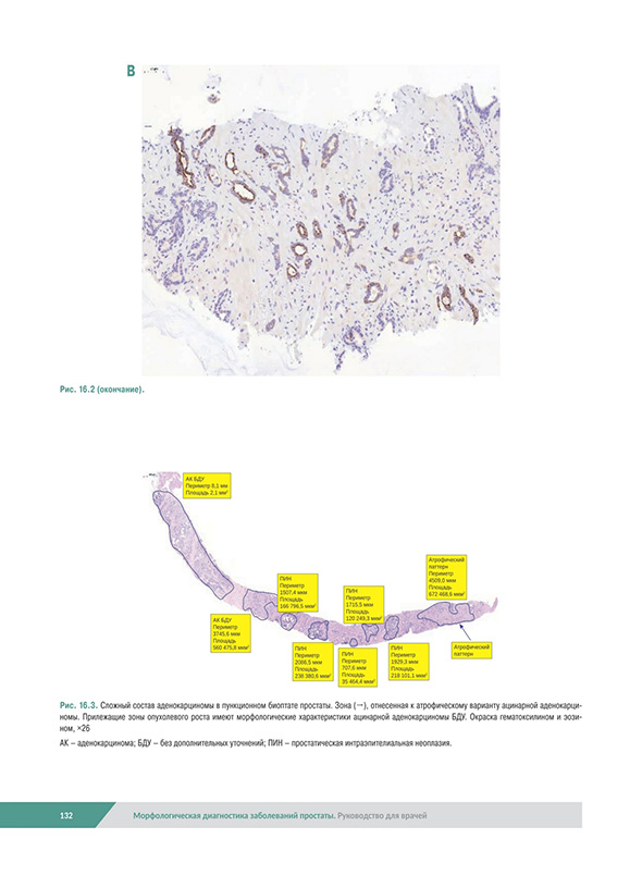 Морфологическая диагностика заболеваний простаты Морфологическая диагностика заболеваний простаты