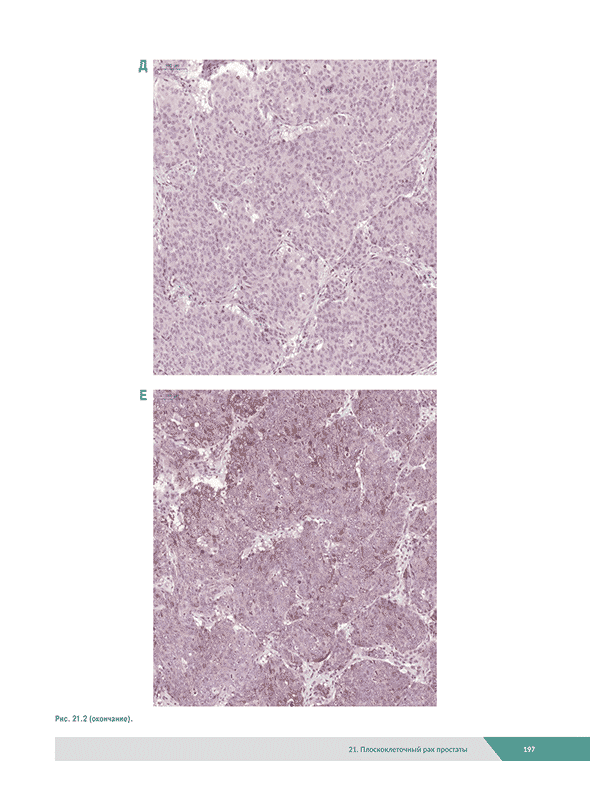 Морфологическая диагностика заболеваний простаты Морфологическая диагностика заболеваний простаты