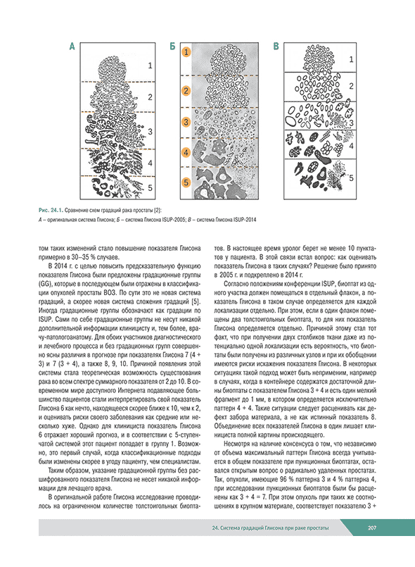 Сравнение схем градаций рака простаты Сравнение схем градаций рака простаты