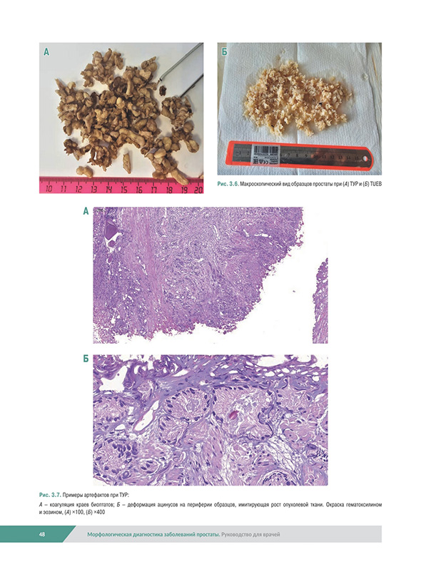 Морфологическая диагностика заболеваний простаты Морфологическая диагностика заболеваний простаты