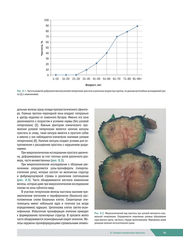 Частота развития доброкачественной узловой гиперплазии простаты Частота развития доброкачественной узловой гиперплазии простаты