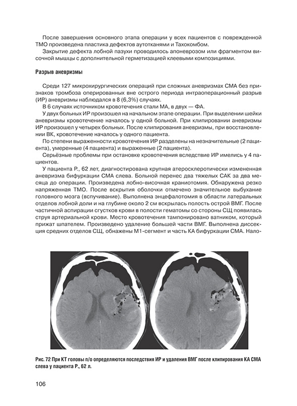 При КТ головы п/о определяются последствия ИР и удаления ВМГ после клипирования