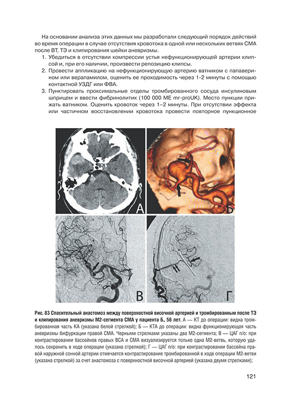Спасительный анастомоз между поверхностном височной артерией и тромбированным после ТЭ