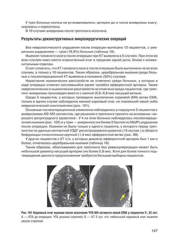 Корковый очаг ишемии после иссечения
