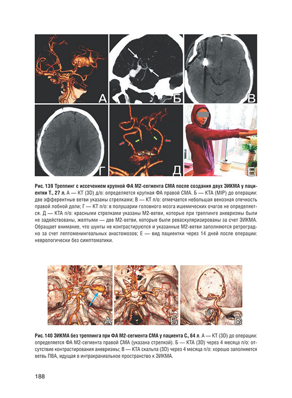 ЭИКМА без треппинга при ФА М2-сегмента СМА у пациента С, 64 л