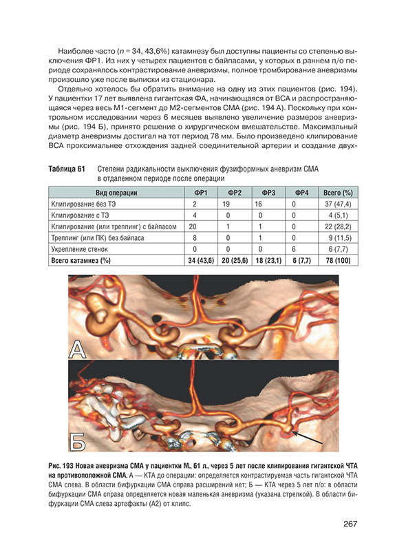 Новая аневризма СМА у пациентки М., 61 г., через 5 лет после клипирования гигантской ЧТА.