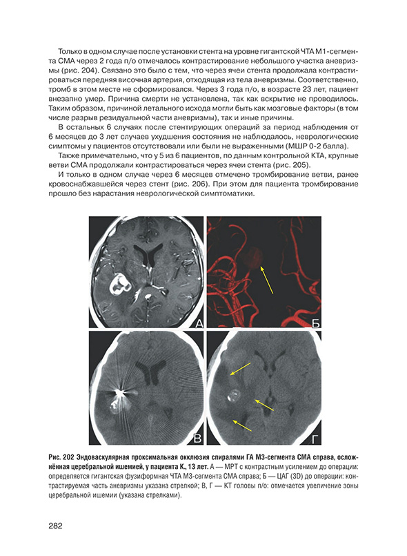 Эндоваскулярная проксимальная окклюзия спиралями ГА МЗ-сегмента СМА.
