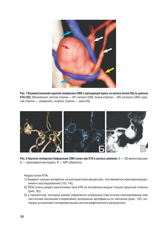 Крупная аневризма бифуркации СМА слева при КТА в разных режимах.,