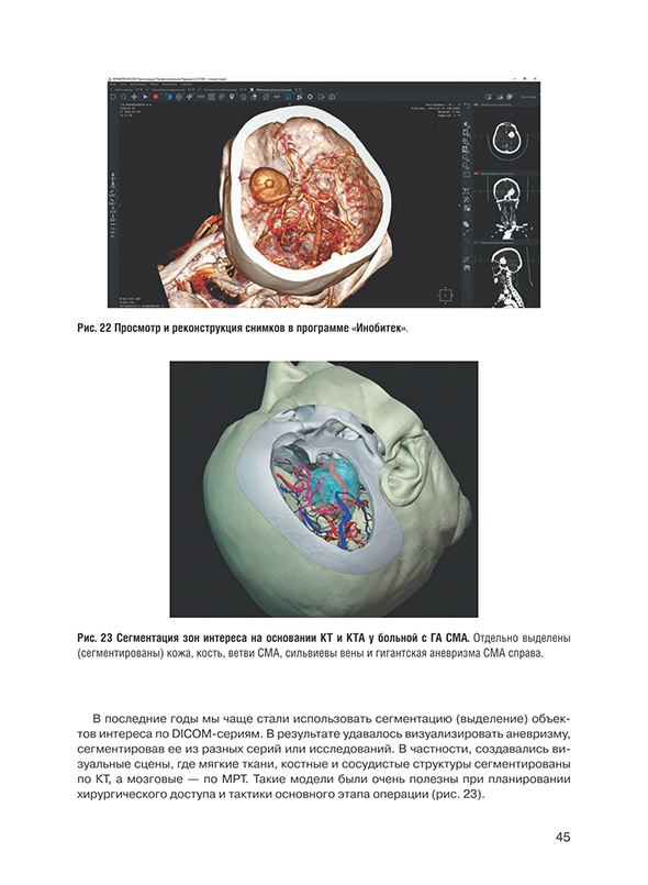Сегментация зон интереса на основании КТ и КТА у больной с ГА СМА.