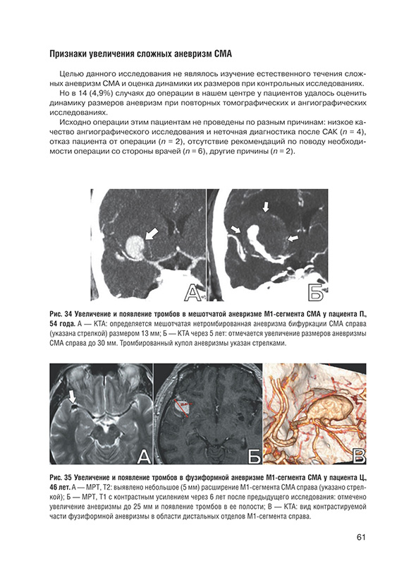 Увеличение и появление тромбов в фузиформной аневризме