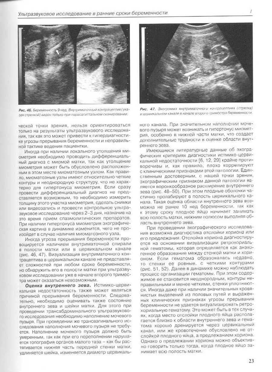 УЗИ сканограмма. Беременность 9 недель