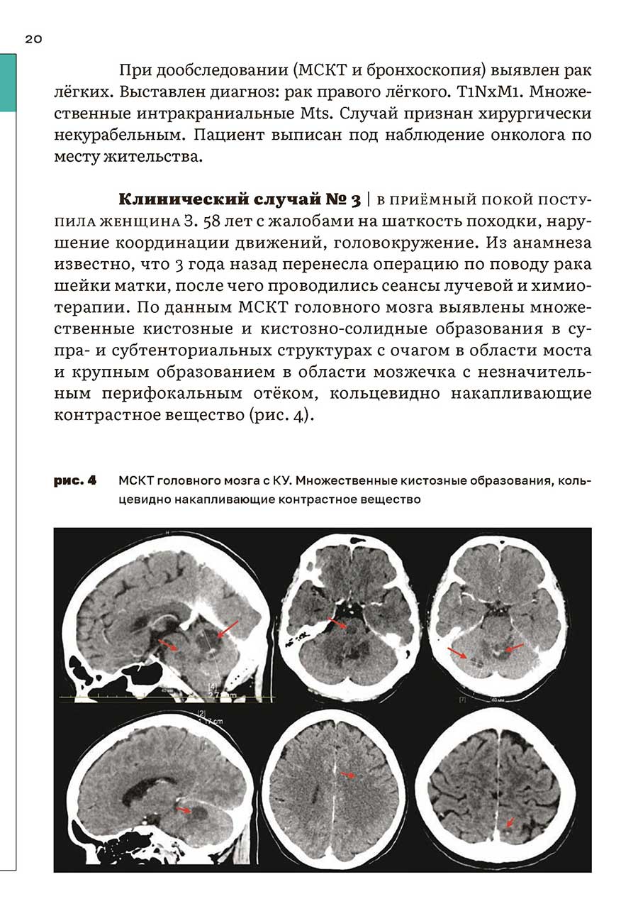 рис. 4 МСКТ головного мозга с КУ.