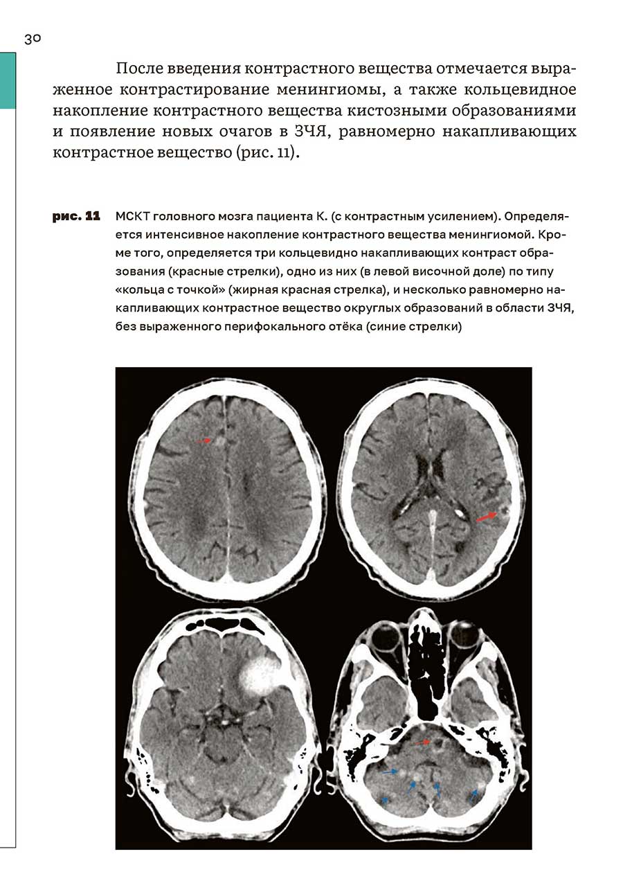Пример страниц из книги "Многоочаговые поражения головного мозга. Вопросы диагностики и лечения. Учебное пособие" - П. Г. Шнякин